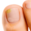 If left untreated, fungal nail infection can become worse and spread.