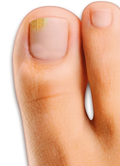 Fungal nail infection affects up to 20% of adult Australians
